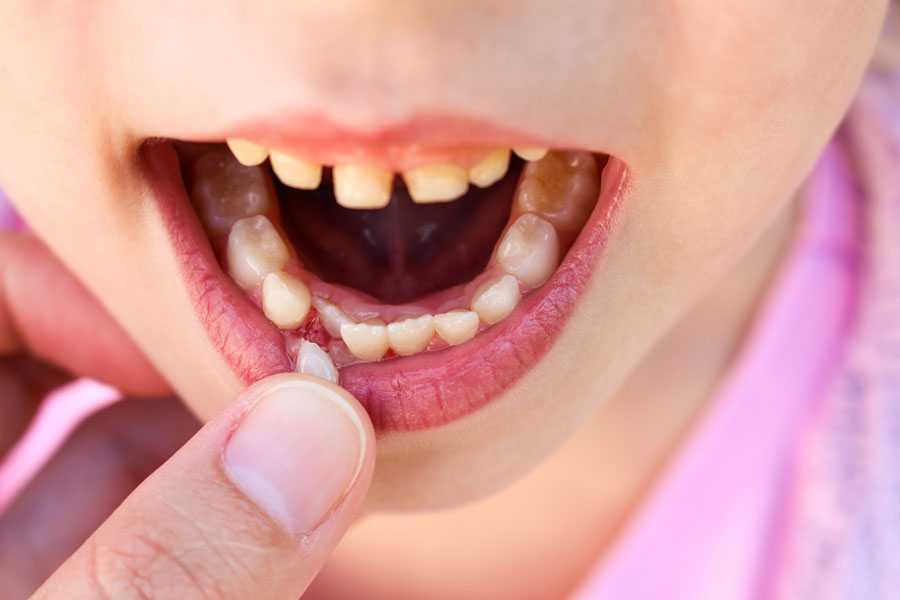 Молочные зубки: лечить или удалить?