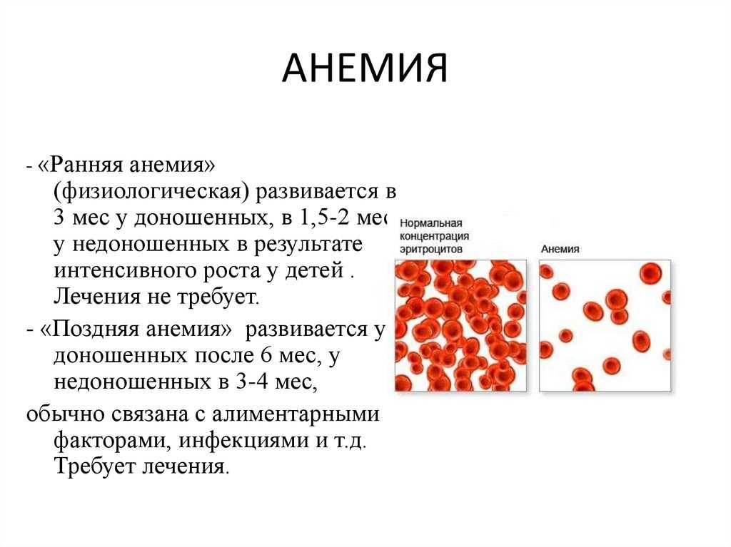 Что такое анемия и чем она опасна для здоровья ребенка?