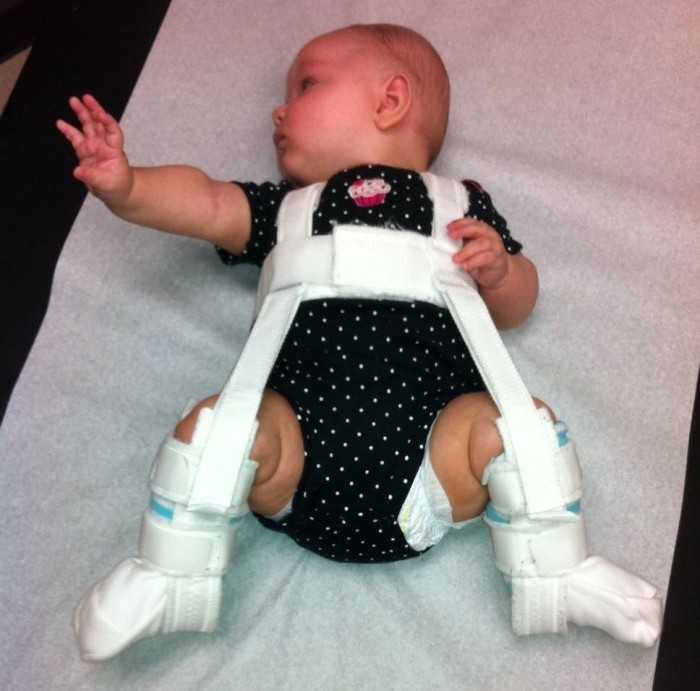 Широкое пеленание при дисплазии тазобедренного сустава у новорожденного