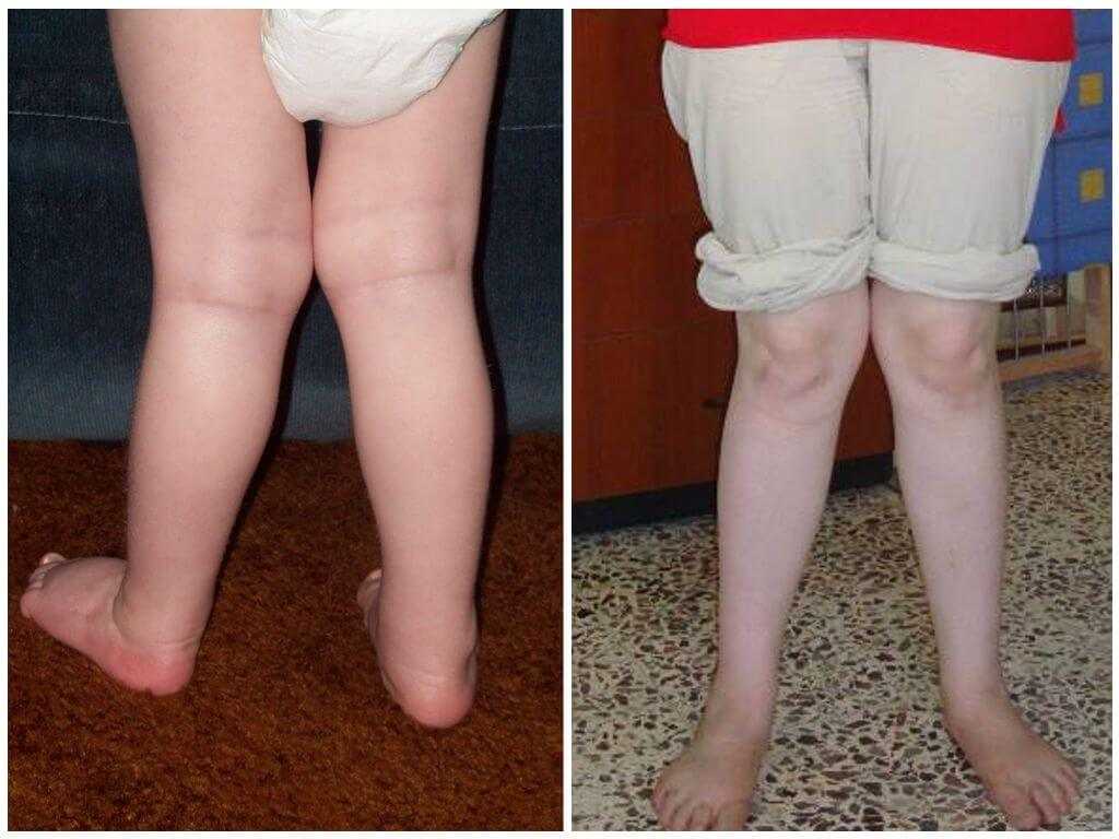 Особенности детского массажа при гипертонусе ног юлия рязанова