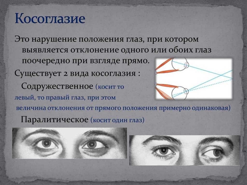 Острота зрения правый глаз левый глаз