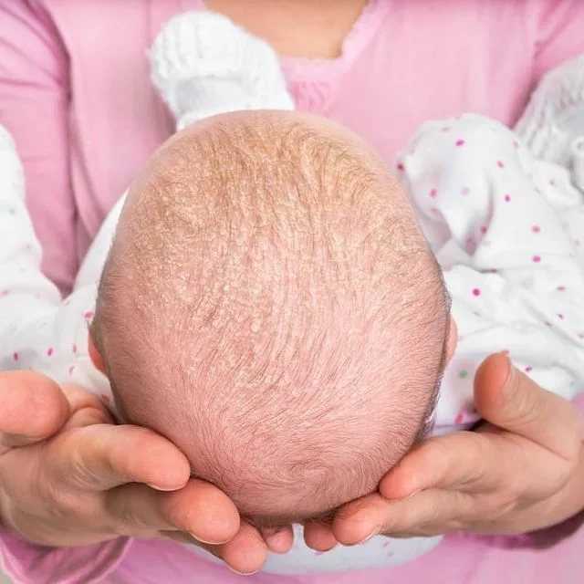 Корочки на голове у ребенка: причины появления, лечение, профилактика