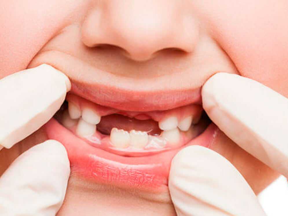 Кариес: причины появления, лечение, профилактика – стоматология президент