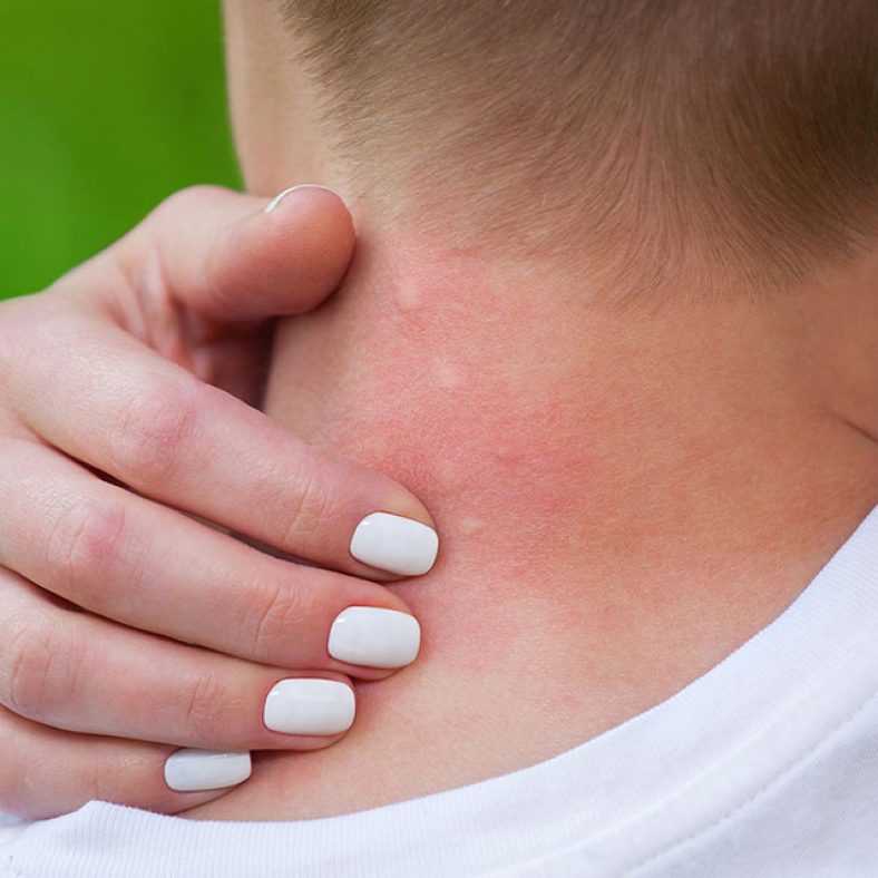 Кожная аллергия - причины, лечение аллергии на коже у детей и взрослых