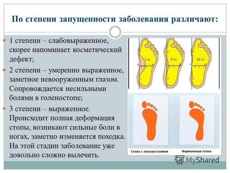 Плоскостопие у детей: как правильно выбрать обувь