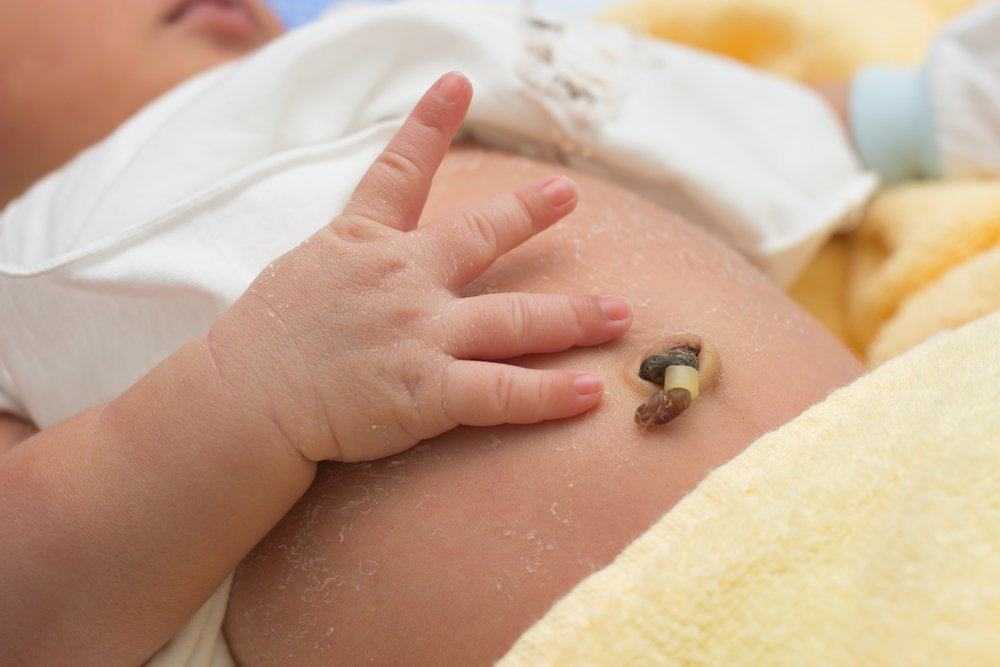 Мокнет пупок у новорожденного