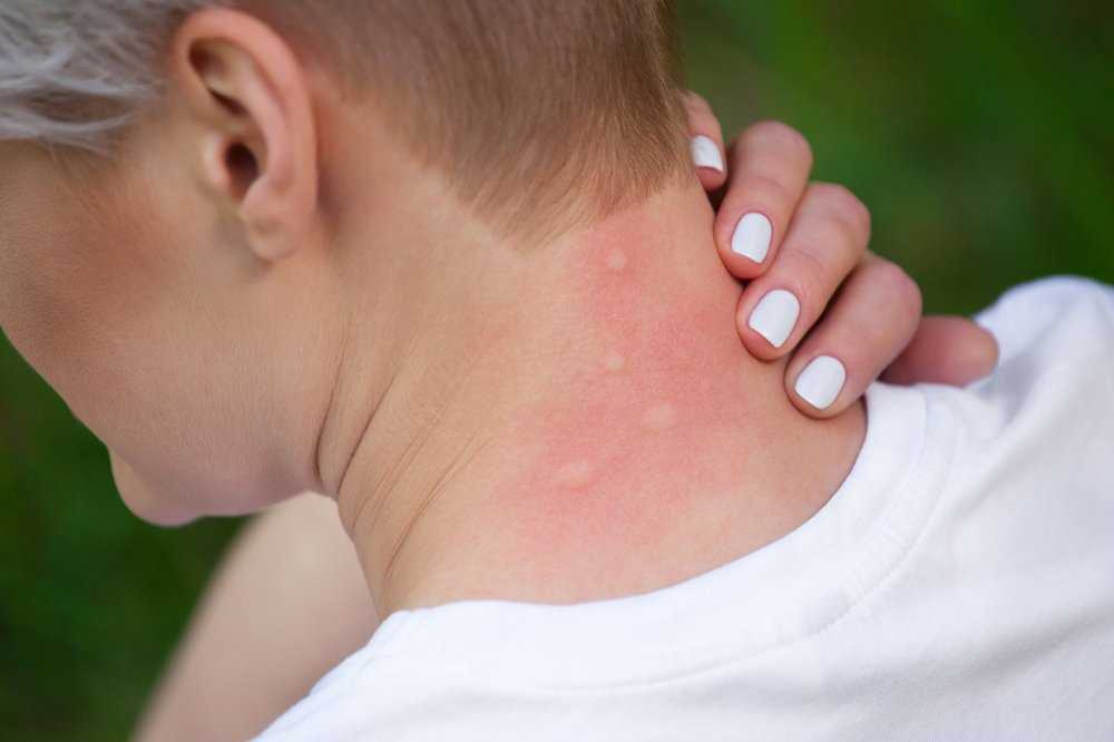 Аллергия на коже у взрослых - симптомы, методы лечения и примеры с фотографиями