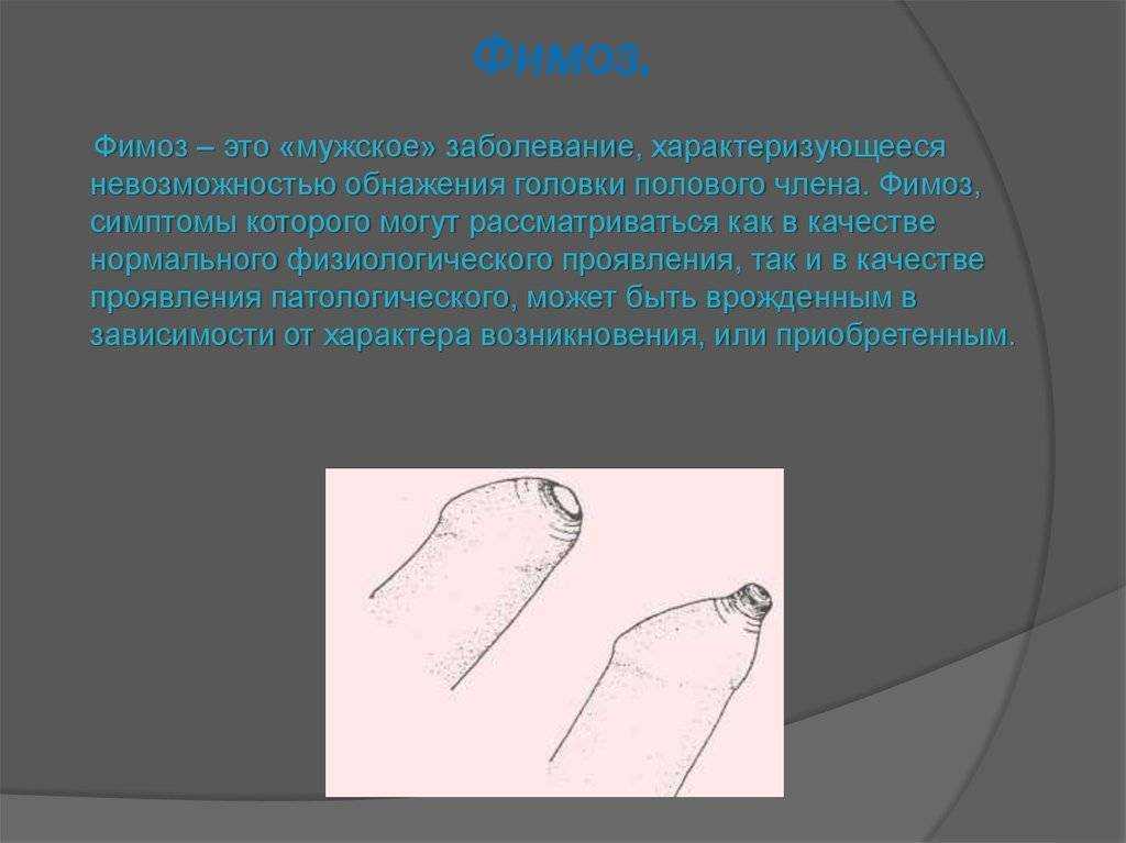 Фимоз и парафимоз (синехии крайней плоти, смегмальные камни) - официальный сайт доктора файзулина