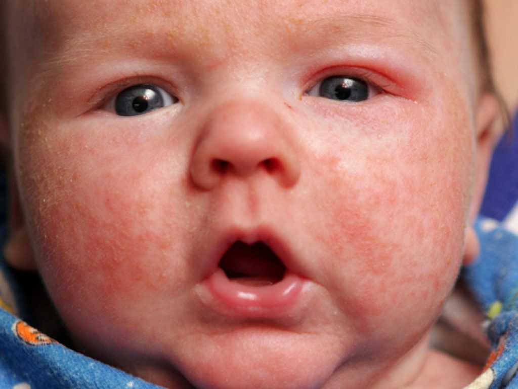 Пищевая аллергия у ребёнка: что делать родителям?