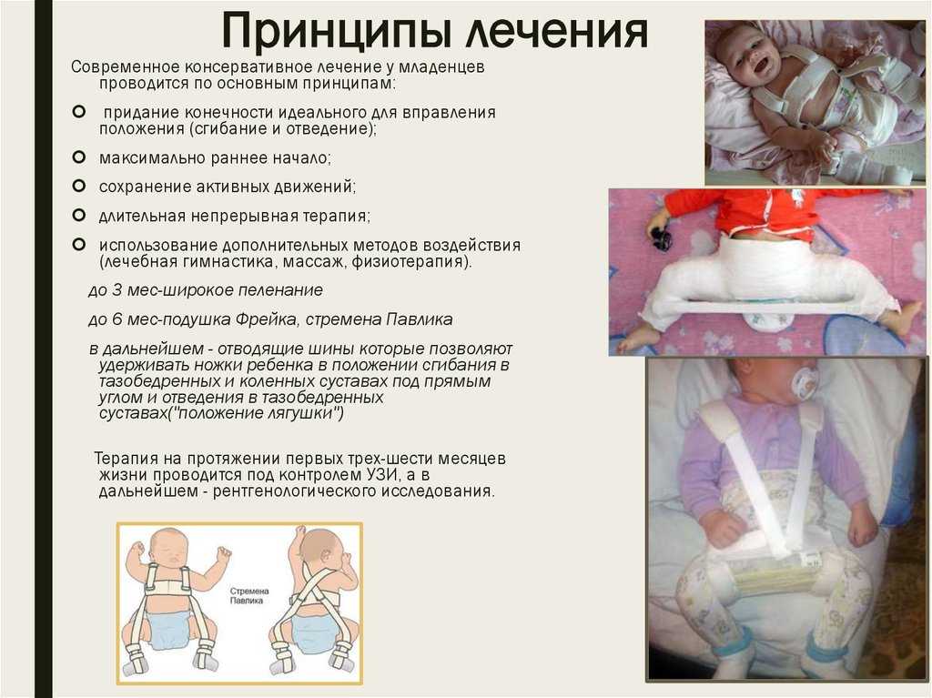 Дисплазия тазобедренных суставов у детей, лечение и симптомы