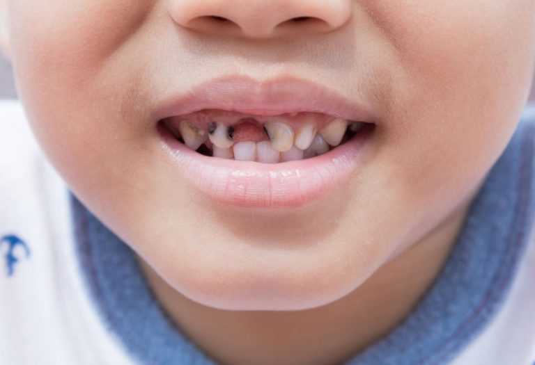 Почему нужно лечить молочные зубы | стоматология президент в новогиреево