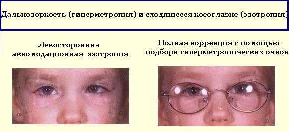 Острота зрения у детей