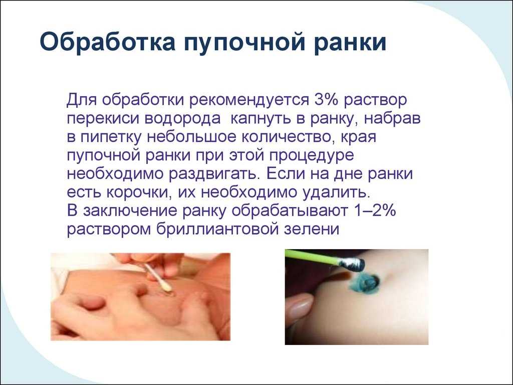 Пупок у новорожденного: как обрабатывать, когда заживет | kukuzya.ru