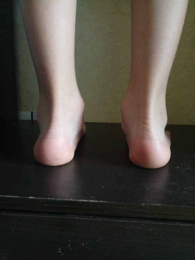 Особенности детского массажа при гипертонусе ног