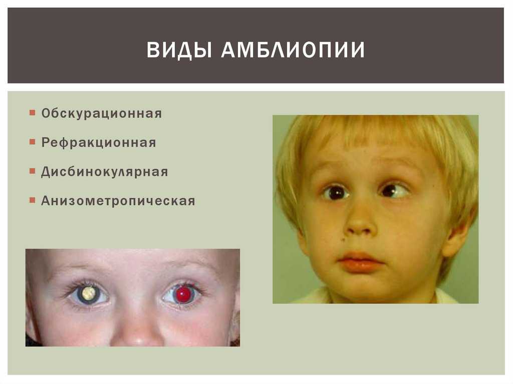 Косоглазие симптомы. Амблиопия. Виды амблиопии. Амблиопия ленивый глаз. Дошкольники с амблиопией.