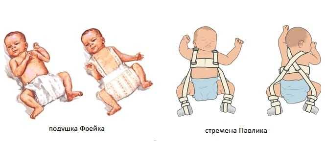 Основные техники пеленания при дисплазии тазобедренных суставов у новорожденных — семейная клиника опора г. екатеринбург