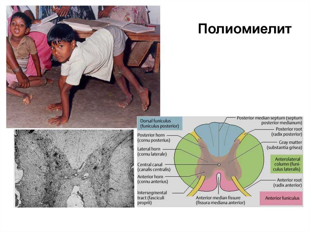 Полиомиелит презентация. Клинические симптомы полиомиелита. Полиомиелит проявления болезни. Паралитический полиомиелит.