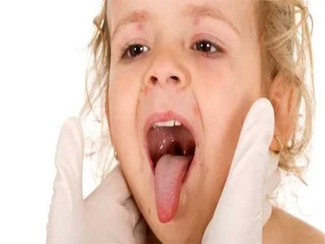 Ангина у детей - лечение, причины, симптомы ангины у ребенка