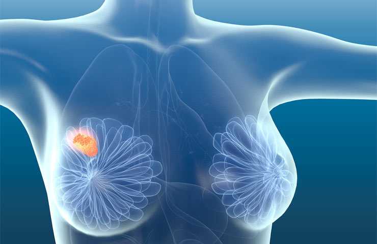 Маммолог-онколог - про женское здоровье, рак груди и местное закаливание