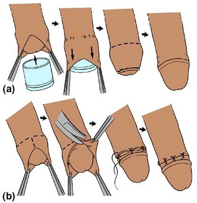 Обрезание крайней плоти у мужчин: причины и последствия. операция по обрезанию у мужчин: фото до и после