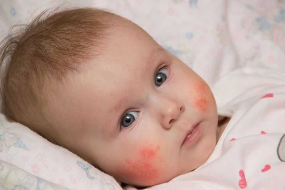 Пищевая аллергия у детей | методы диагностики и лечения в санкт-петербурге - детский аллерголог см-клиника