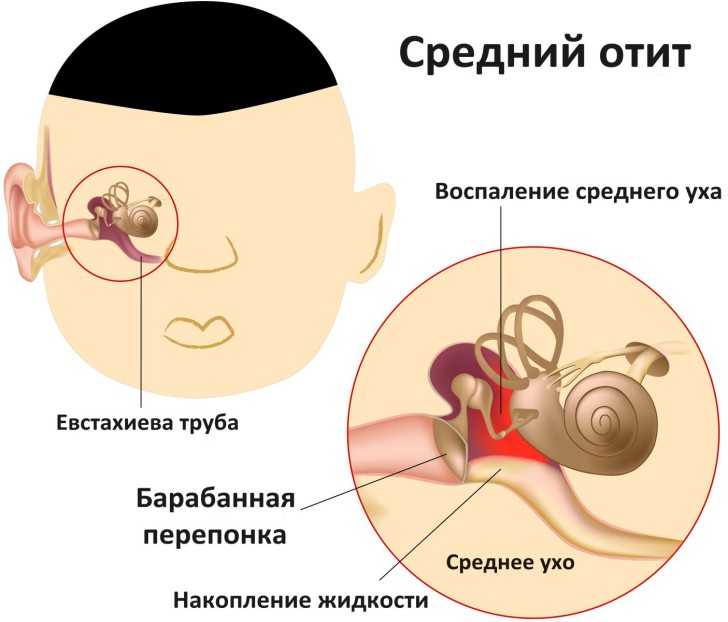 Средний отит. лечение отита среднего уха у ребенка