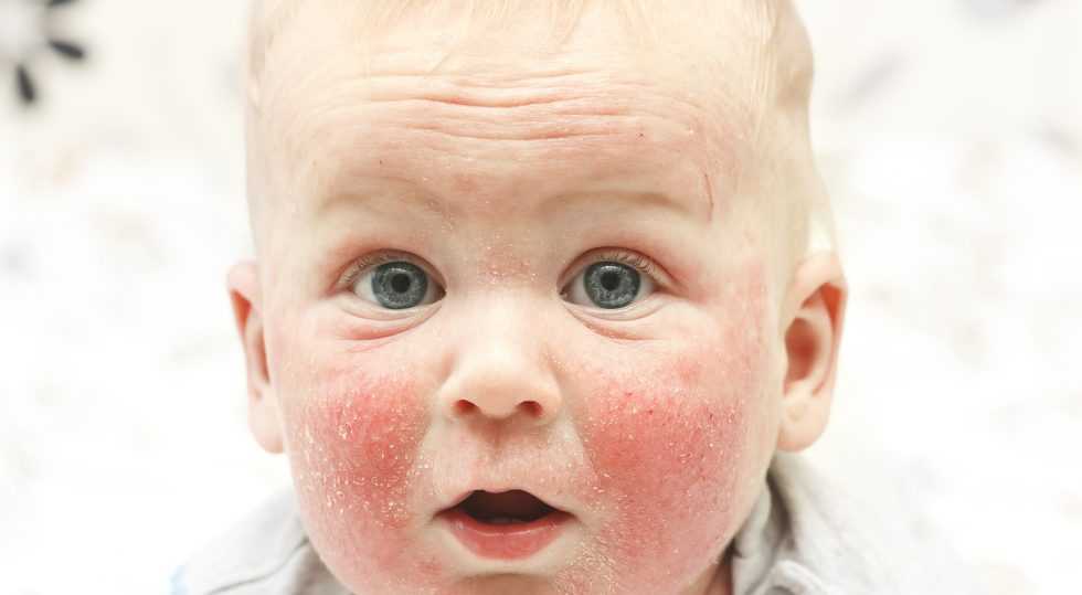 Как аллерголог выявляет аллергию у детей | диагностика