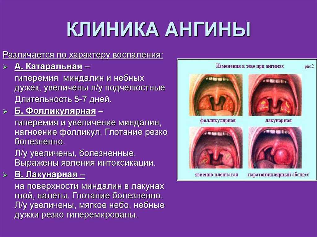 Ангина у ребенка: вирусная, грибковая, фолликулярная, катаральная симптомы и лечение