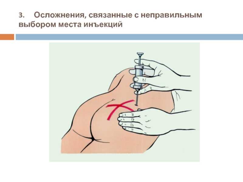 Уколы. всегда ли это больно?