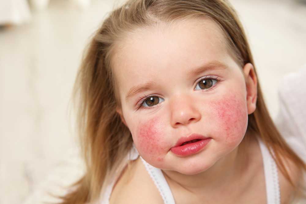 Аллергия у детей - как лечить аллергию у детей?