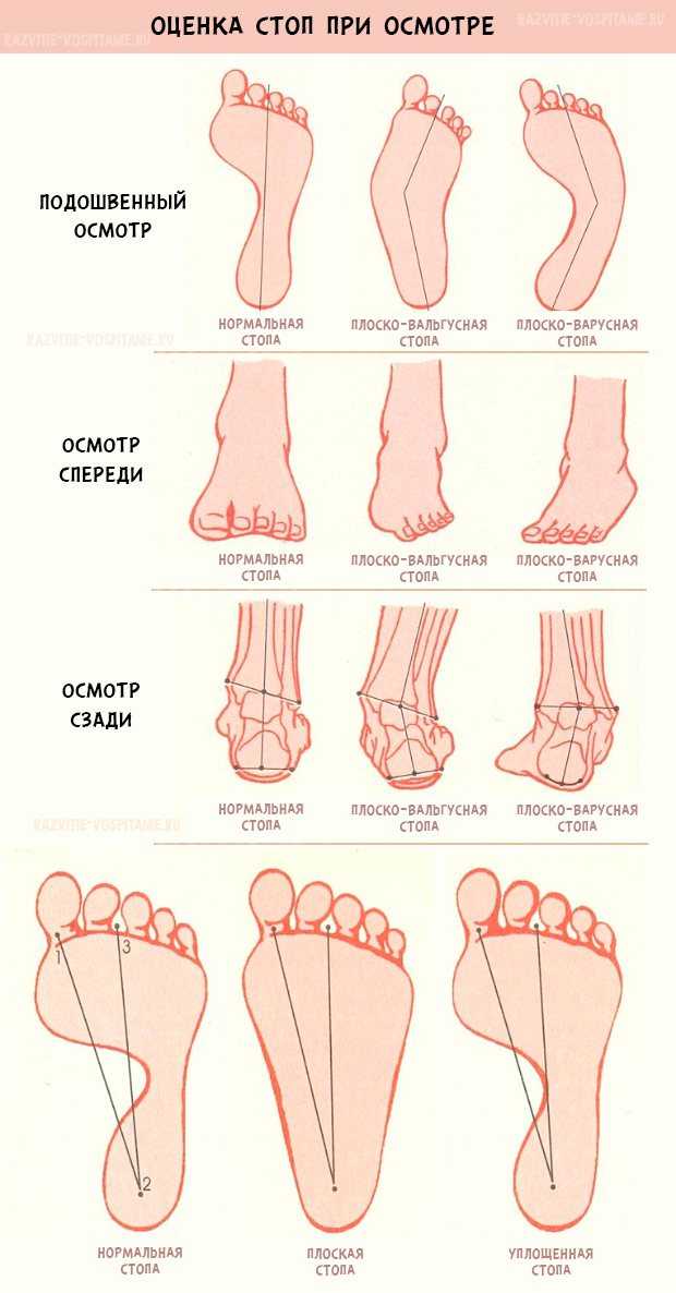 Вальгусная деформация стопы у новорожденного фото
