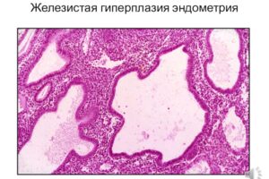 Железистая гиперплазия эндометрия матки