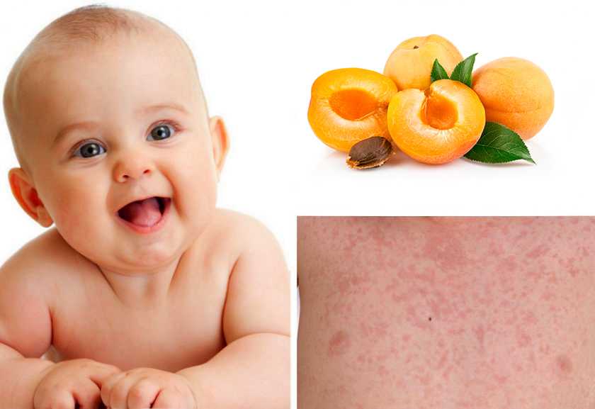 Пищевая аллергия у детей - симптомы, способы лечения, диета